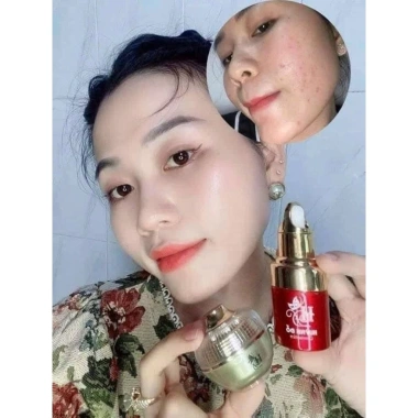 Combo Mụn Huỳnh Đỗ 3 trong 1: Sữa rửa mặt, Kem mụn, Serum giảm mụn, mờ thâm, dưỡng trắng da – 135.000₫ 2