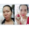 Combo Mụn Huỳnh Đỗ 3 trong 1: Sữa rửa mặt, Kem mụn, Serum giảm mụn, mờ thâm, dưỡng trắng da – 135.000₫ 4