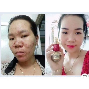 Combo Mụn Huỳnh Đỗ 3 trong 1: Sữa rửa mặt, Kem mụn, Serum giảm mụn, mờ thâm, dưỡng trắng da – 135.000₫ 4