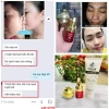 Combo Mụn Huỳnh Đỗ 3 trong 1: Sữa rửa mặt, Kem mụn, Serum giảm mụn, mờ thâm, dưỡng trắng da – 135.000₫ 9