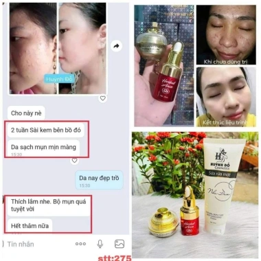 Combo Mụn Huỳnh Đỗ 3 trong 1: Sữa rửa mặt, Kem mụn, Serum giảm mụn, mờ thâm, dưỡng trắng da – 135.000₫ 9