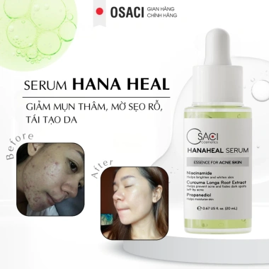 Combo Ngừa mụn & Thâm sẹo Osaci Hana Heal + Serum Luna Lush 20ml + Kem UmiSunBlock - 653.040₫