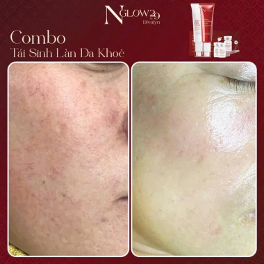 Combo tái sinh Dưỡng da Trắng sáng Tăng Collagen Ngăn lão NGLOW29 2.304tr