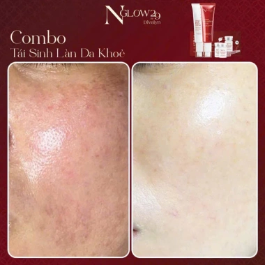 Combo tái sinh Dưỡng da Trắng sáng Tăng Collagen Ngăn lão NGLOW29 2.304tr