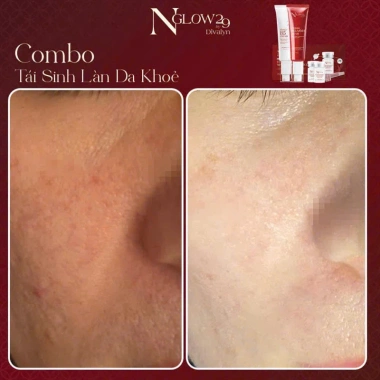 Combo tái sinh Dưỡng da Trắng sáng Tăng Collagen Ngăn lão NGLOW29 2.304tr