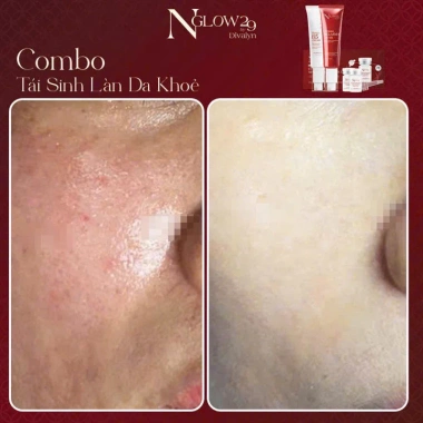 Combo tái sinh Dưỡng da Trắng sáng Tăng Collagen Ngăn lão NGLOW29 2.304tr