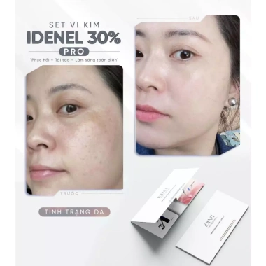 Combo vi kim sinh học 30% chăm sóc da mặt - Dưỡng sâu, giảm mụn, giá 380.000₫