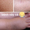 Da vảy cá (Da rắn) Kem dưỡng da công thức cải tiến - Giá chỉ 244.000₫ 5