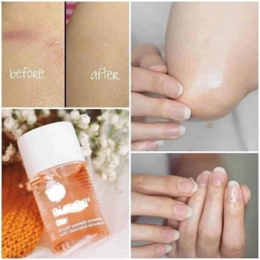 Dầu Dưỡng Da Body Bl0 Oil Giảm Rạn Da 200ml Fullbox - Siêu Giảm Giá 1.068.000 VND 2 Dầu Dưỡng Da Body Bl0 Oil Giảm Rạn Da 200ml Fullbox - Siêu Giảm Giá 1.068.000 VND 2