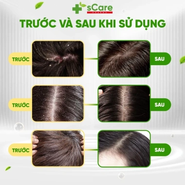 Dầu Gội sCare Sạch Gàu - Giảm Gàu, Bong Tróc, Ngứa, Nấm Da Đầu, Dược Liệu 219k 5