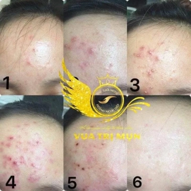 FREESHIP 50K Serum Turmeric Giảm Mụn Thâm Rỗ 72h Giá chỉ 405k Mỹ phẩm Thế Giới 3