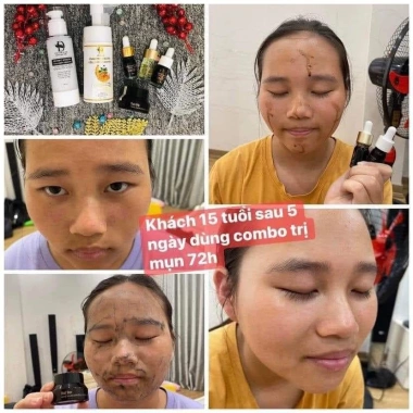 FREESHIP 50K Serum Turmeric Giảm Mụn Thâm Rỗ 72h Giá chỉ 405k Mỹ phẩm Thế Giới 5