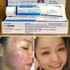 Gamma Derma Forte Kem Mờ Thâm Mụn 15g - Giảm Sưng Đỏ, Dưỡng Da, Giá 90.000 2