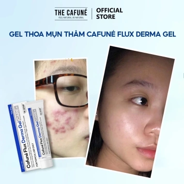 Gel chấm Mụn Thâm Cafuné Flux Derma Essence - Giảm Mụn, Mờ Thâm, Ngừa Mụn cho mọi loại da, giảm còn 119.000₫ 4