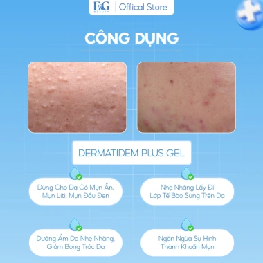Gel DERMATIDEM PLUS 20g - Giảm mụn, mờ thâm nhanh, khô cồi, trị mụn viêm và ẩn, chỉ 140.000đ 3