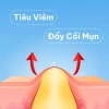 Gel DERMATIDEM PLUS 20g - Giảm mụn, mờ thâm nhanh, khô cồi, trị mụn viêm và ẩn, chỉ 140.000đ 5