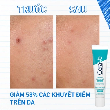 Gel giảm mụn CeraVe Blemish Control 40ml - Không khô da, giá chỉ 365.000đ 3