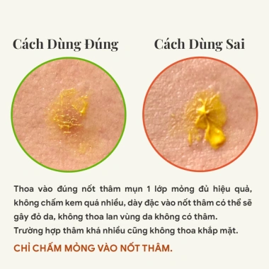 Giảm thâm mụn nhanh chóng với Kem chấm mờ thâm mụn Giggle 5g - Giá ưu đãi 186.000đ