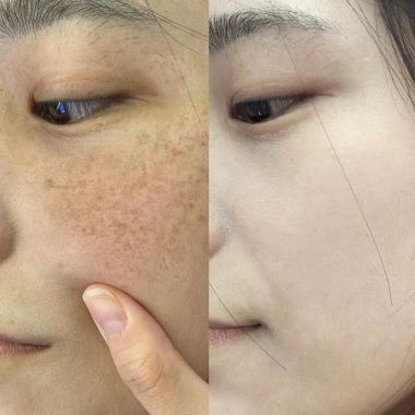 Hộp 10 Ống 377 Tinh Chất Kem Niacinamide - Làm Trắng Da, Chống Tàn Nhang, Cải Thiện Xỉn Màu - 28.000 VND 5