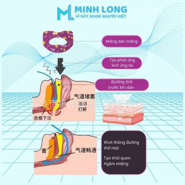 Hộp 30 miếng Dán Chống Hở Miệng Khi Ngủ Sleep 65x45mm - Ngừa Nghiến Răng Vật Lý 2