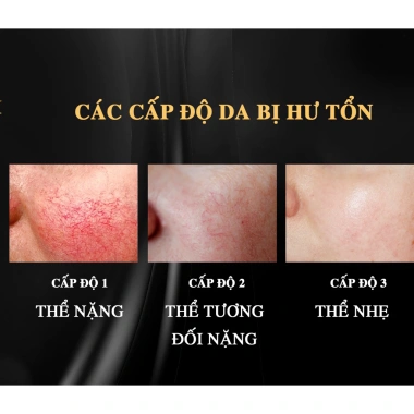 Hot Kem Mao Mạch Baby Milk 20g – Phục Hồi Da Đỏ Nhiễm Corticoid, Hàng Hiệu Cao Thiên Nhi, Giá 550k 2