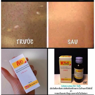 Kela Lotion 30ml Dưỡng ẩm và Se Khít Lỗ Chân Lông, Giảm Viêm Lỗ, Giá 269.000 VND - Giảm Giá Đặc Biệt 3 Kela Lotion 30ml Dưỡng ẩm và Se Khít Lỗ Chân Lông, Giảm Viêm Lỗ, Giá 269.000 VND - Giảm Giá Đặc Biệt 3