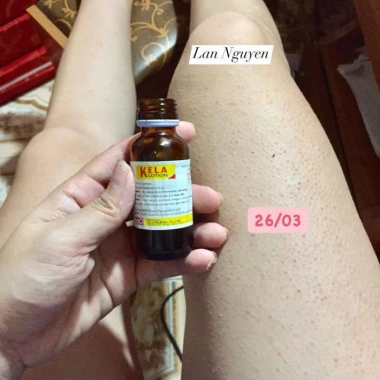 Kela Lotion 30ml Dưỡng ẩm và Se Khít Lỗ Chân Lông, Giảm Viêm Lỗ, Giá 269.000 VND - Giảm Giá Đặc Biệt