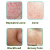 Kem Axit Salicylic 15% - Azelaic 30ml Giảm Mụn Đầu Đen, Mụn Trứng Cá, Da Sáng Mịn 2