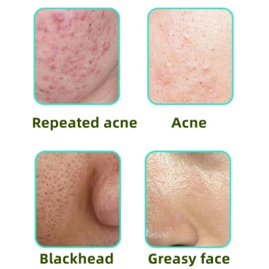 Kem Axit Salicylic 15% - Azelaic 30ml Giảm Mụn Đầu Đen, Mụn Trứng Cá, Da Sáng Mịn