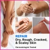Kem Axit Salicylic 2 Khuỷu Tay 40% Urea – Xóa Vết Chai Sần, Dưỡng Cơ Thể Nứt Nẻ, Giá chỉ 83.600đ 6