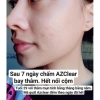 Kem AZCLEAR Action Lotion 25gr - Giảm mụn nhanh, mờ thâm, chỉ 400.000₫ 2