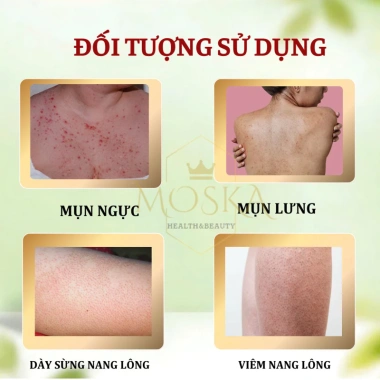 Kem Bôi Da Liễu Urea - Xử Lý Viêm Nang Lông, Dây Sừng, Mụn, Sáng Mịn & Căng ẩm - 90k 4