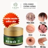 Kem bôi da Ngứa ghẻ lâu năm 180k - Giảm còn 150k, trị nấm, tổ đỉa, hắc lào, mề đay, muỗi đốt