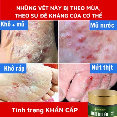 Kem bôi da Ngứa ghẻ lâu năm 180k - Giảm còn 150k, trị nấm, tổ đỉa, hắc lào, mề đay, muỗi đốt