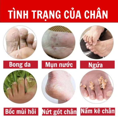 Kem bôi da Ngứa ghẻ lâu năm 180k - Giảm còn 150k, trị nấm, tổ đỉa, hắc lào, mề đay, muỗi đốt