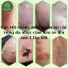 Kem bôi da Ngứa ghẻ lâu năm 180k - Giảm còn 150k, trị nấm, tổ đỉa, hắc lào, mề đay, muỗi đốt 6