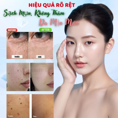 Kem Bôi Mụn Thịt EELHOE 20ml - Bóc Tách Mụn Cóc, Không Thâm Sẹo, Ngừa Tái Phát - BK INNO - Giá 89.000đ 9