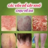 Kem bôi ngoài da HEYOUL Hàn Quốc trị sừng, chàm, nấm hắc lào, viêm da - 75.000₫ 5