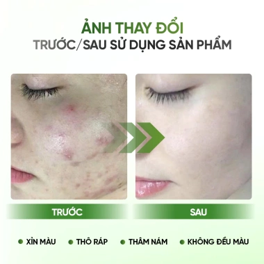 Kem Cao Khổ Qua 10ml Dành Cho Nữ - Giảm Mụn Hiệu Quả, Dưỡng Da Sáng Mịn