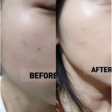 Kem chấm mụn AC CLEAR SPOT giảm mụn nhanh, giá sale 100.000 - hiệu quả ngay