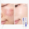 Kem Chấm Mụn Decumar ProMax 15g giảm mụn sưng đỏ mạnh mẽ, mờ thâm sẹo, 160.000 VND 6