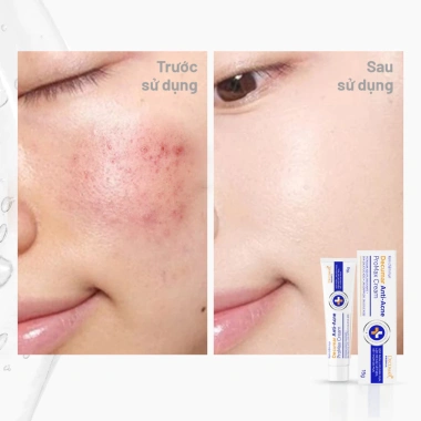 Kem Chấm Mụn Decumar ProMax 15g giảm mụn sưng đỏ mạnh mẽ, mờ thâm sẹo, 160.000 VND 6