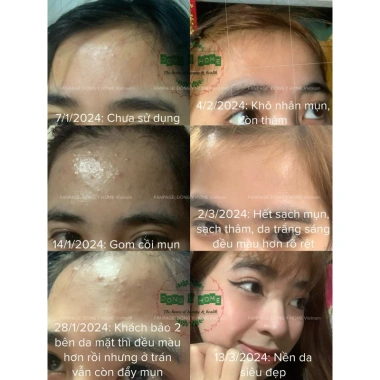 Kem Chấm Mụn Đông Y Home 20g - Giảm Thâm, Làm Đẹp Da, Skincare, Giá 197.160 VND 5