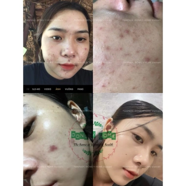 Kem Chấm Mụn Đông Y Home 20g - Giảm Thâm, Làm Đẹp Da, Skincare, Giá 197.160 VND 7