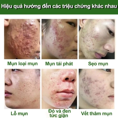 Kem chấm mụn serum BHA se khít lỗ chân lông, xóa mụn nhanh, dịu nhẹ chỉ 145.000 VND