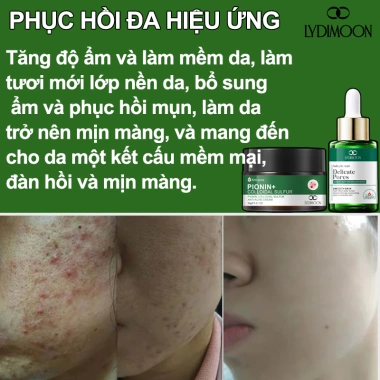 Kem chấm mụn serum BHA se khít lỗ chân lông, xóa mụn nhanh, dịu nhẹ chỉ 145.000 VND 3 Kem chấm mụn serum BHA se khít lỗ chân lông, xóa mụn nhanh, dịu nhẹ chỉ 145.000 VND 3