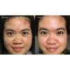 Kem chấm mụn thâm siêu tốc Dr Skinacne - Giảm giá 89k, trị mụn nhanh, da sạch không thâm 4