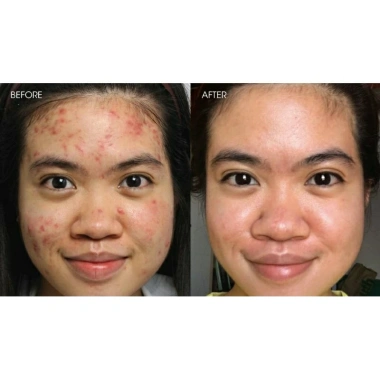 Kem chấm mụn thâm siêu tốc Dr Skinacne - Giảm giá 89k, trị mụn nhanh, da sạch không thâm 4