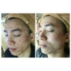Kem chấm mụn thâm siêu tốc Dr Skinacne - Giảm giá 89k, trị mụn nhanh, da sạch không thâm 5
