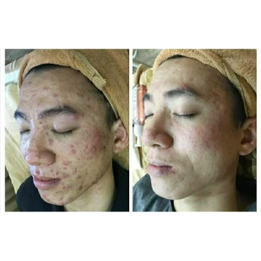 Kem chấm mụn thâm siêu tốc Dr Skinacne - Giảm giá 89k, trị mụn nhanh, da sạch không thâm 5